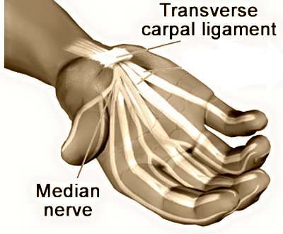 How To Deal With Carpal Tunnel Pain